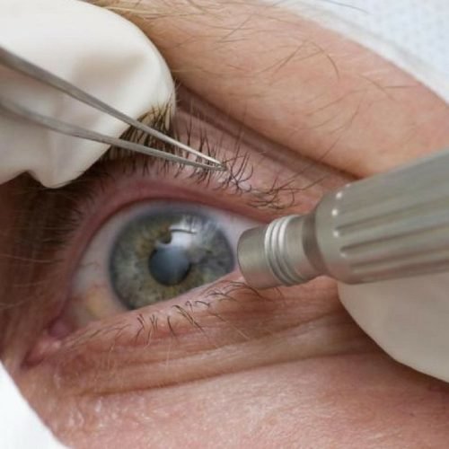 Lula faz cirurgia de catarata; entenda a doença e o procedimento